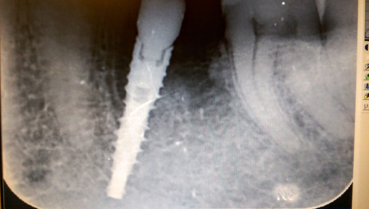 azonnal terhelhető implantátum